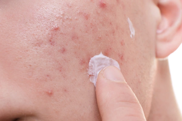 Nakładanie kremu na twarz z niedoskonałościami